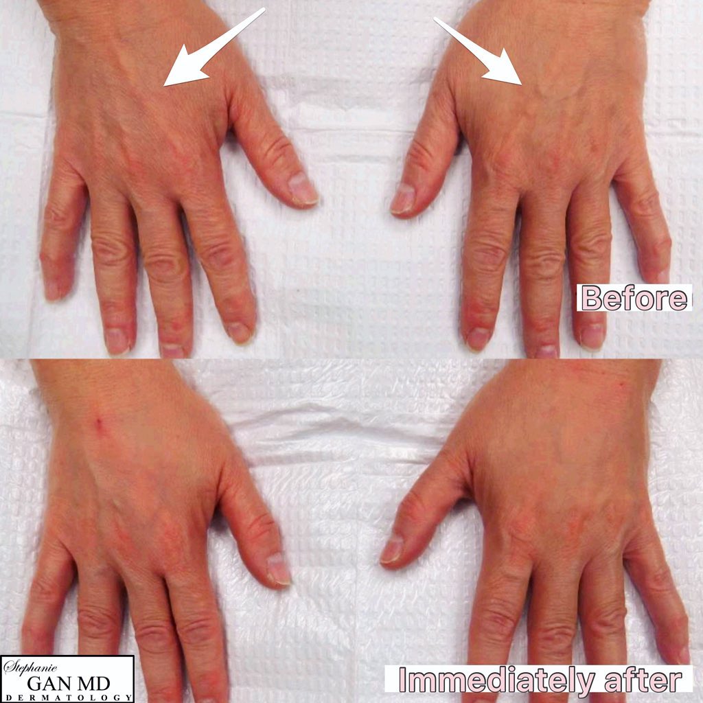 Instagram post by Dr. Stephanie Gan: Turn back the hands of time in less than 🖐 (five) minutes! ⁣ ⁣ Just like the face, the hands show the effect of age-related volume loss and…