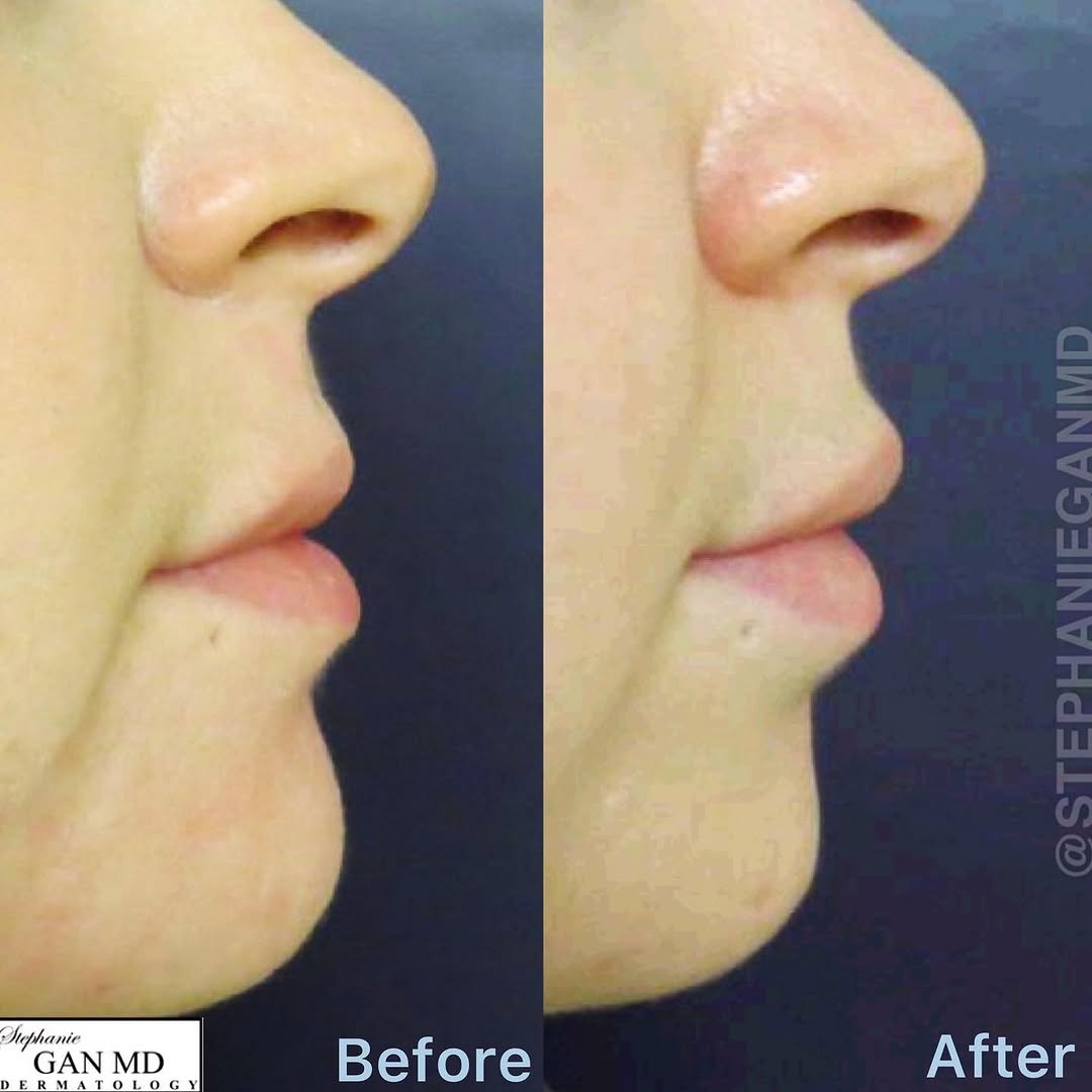 Instagram post by Dr. Stephanie Gan: Pretty lip enhancement without filler ⁣ ⁣ A nice, natural pout is seen 2 weeks after a small amount of Botox is placed around the mouth. ⁣ ⁣…