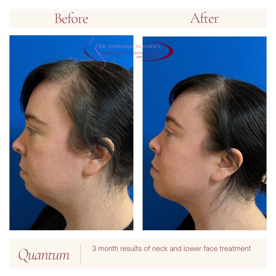 Instagram post by Dr. Stephanie Molden: Tighter neck and jawline in just 3 months after Quantum rf treatment! Done in the office, quick recovery and amazing results! Book a consult…