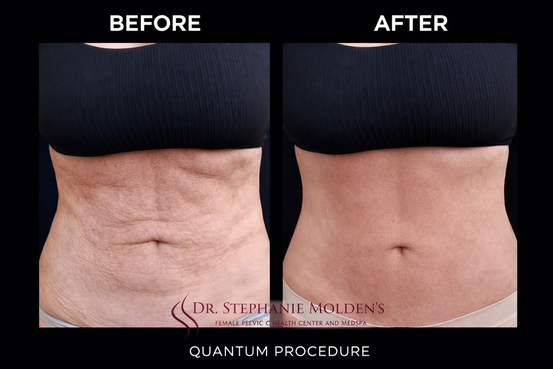 Instagram post by Dr. Stephanie Molden: Quantum Body Contouring ✨ Non-surgical tightening + contouring of the abdomen with visible smoothing and improved skin quality. ✔️ No downti…