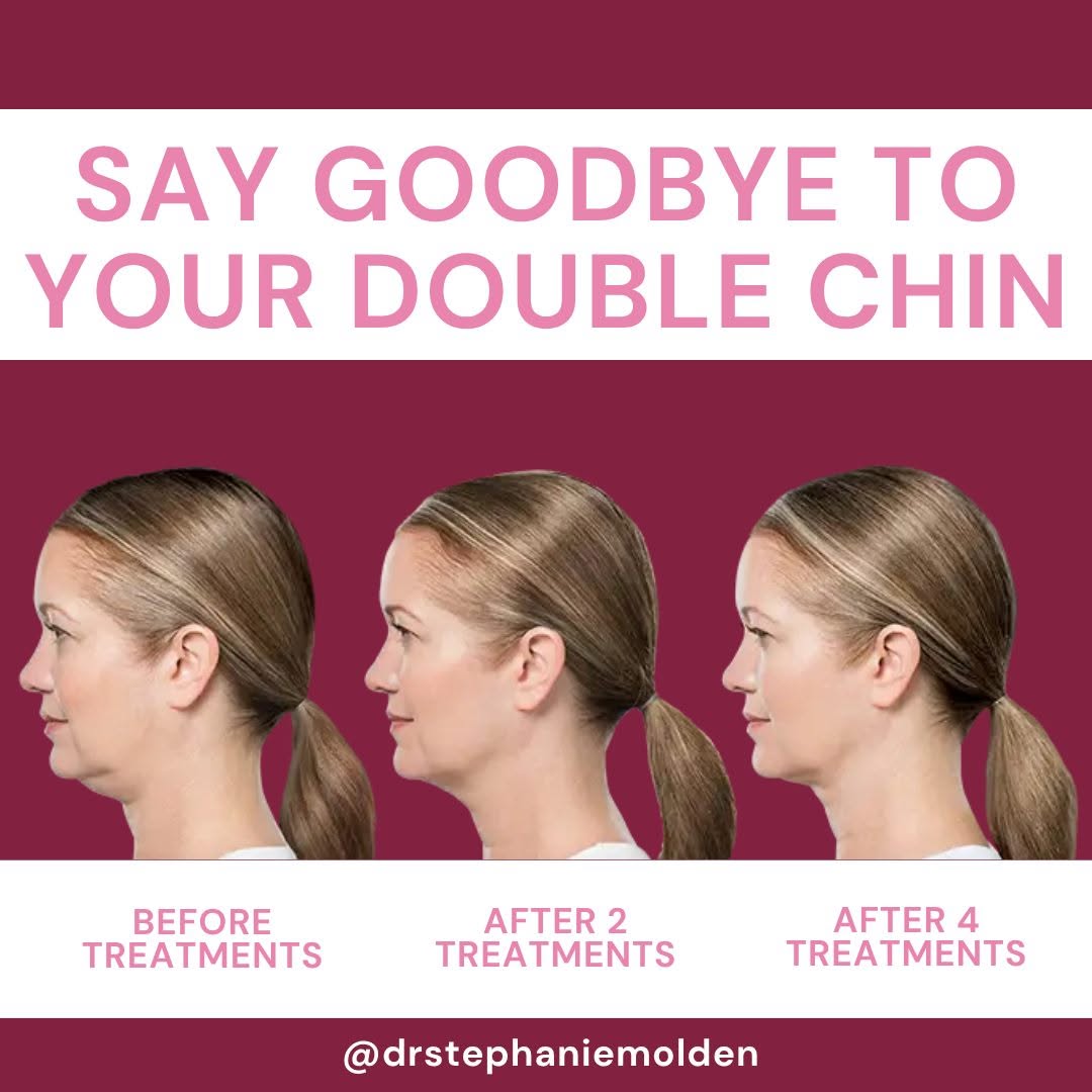 Instagram post by Dr. Stephanie Molden: Say goodbye to stubborn chin fat. ✨ Kybella® is a non-surgical treatment designed to reduce fat beneath the chin and create a more defined j…