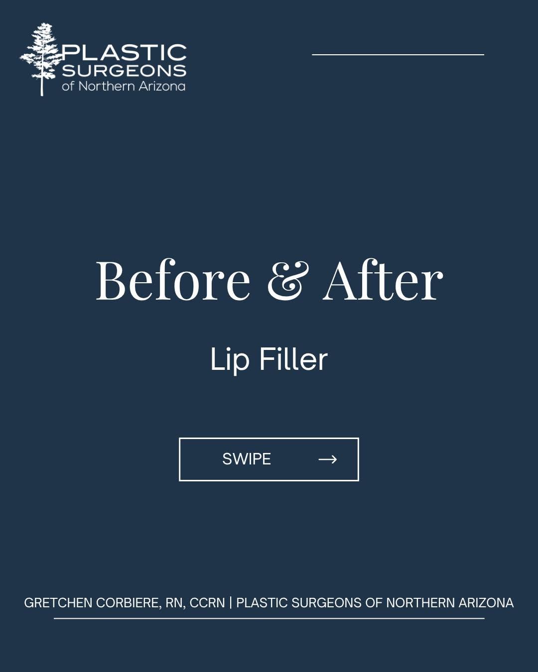 Instagram post by Dr. Stephen F. Lex: A little enhancement can make a beautiful difference. ✨ This lip filler before & after by Gretchen Corbiere, RN, CCRN shows how subtle volum…
