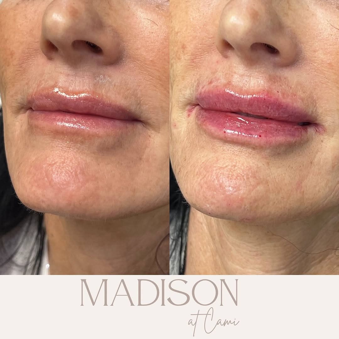 Instagram post by Dr. Stephen Giordano, DO: Obsessed with this lip filler before and after! 💉👄 My gorgeous patient requested more volume to her lips for a refreshed look, and she had…