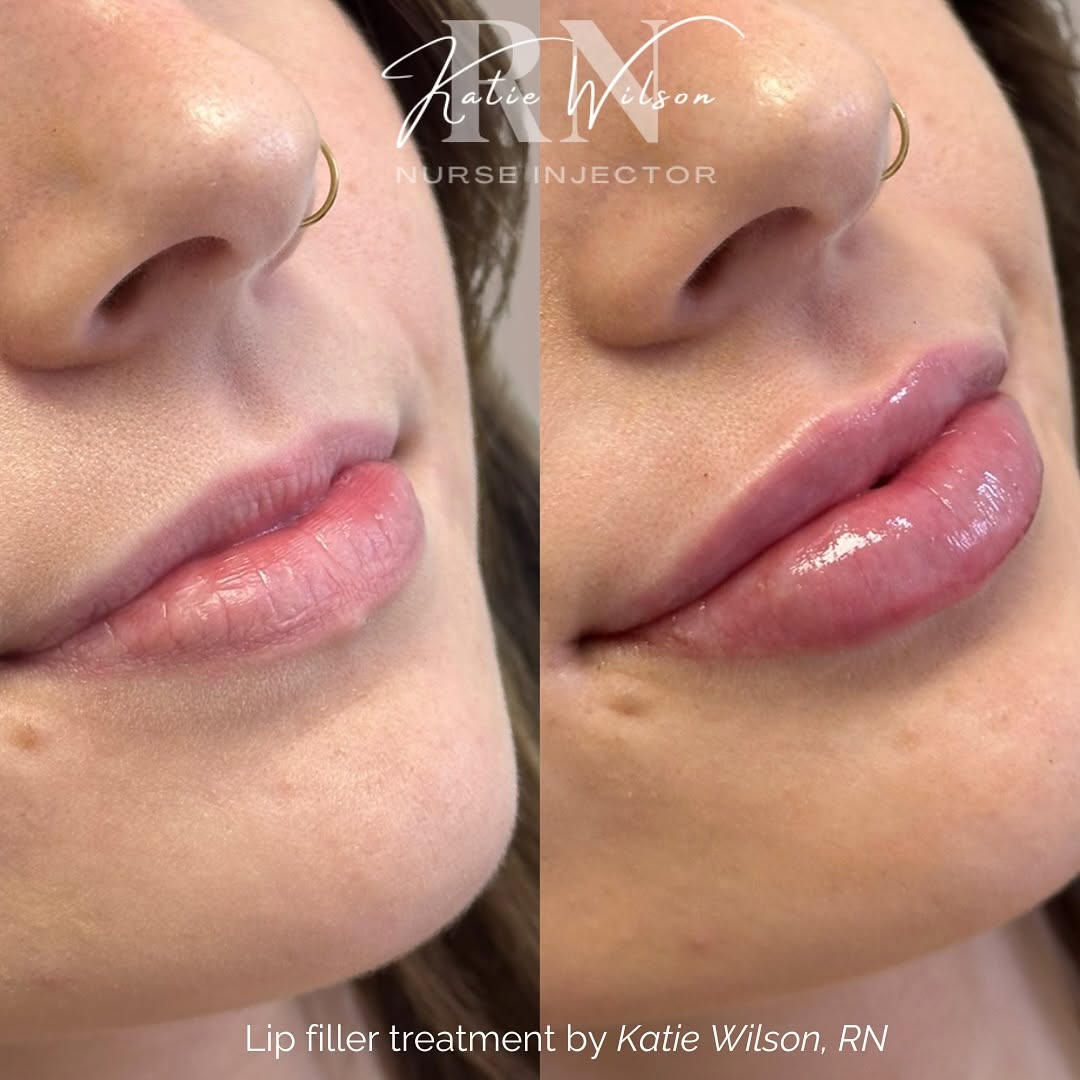 Instagram post by Dr. Stephen Giordano, DO: Enhancing smiles, one syringe of lip filler at a time!💋 Treatment: 1.0mL lip filler Downtime: Mild-moderate bruising and swelling for 5-10 …
