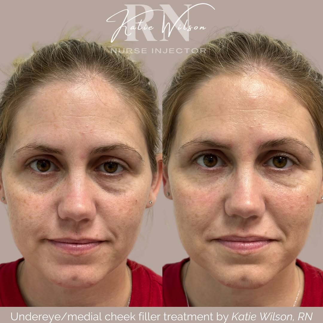 Instagram post by Dr. Stephen Giordano, DO: Refreshed and balanced, is the perfect way to describe this result! ✨ Treatment: undereye and medial cheek dermal filler Downtime: mild-mode…