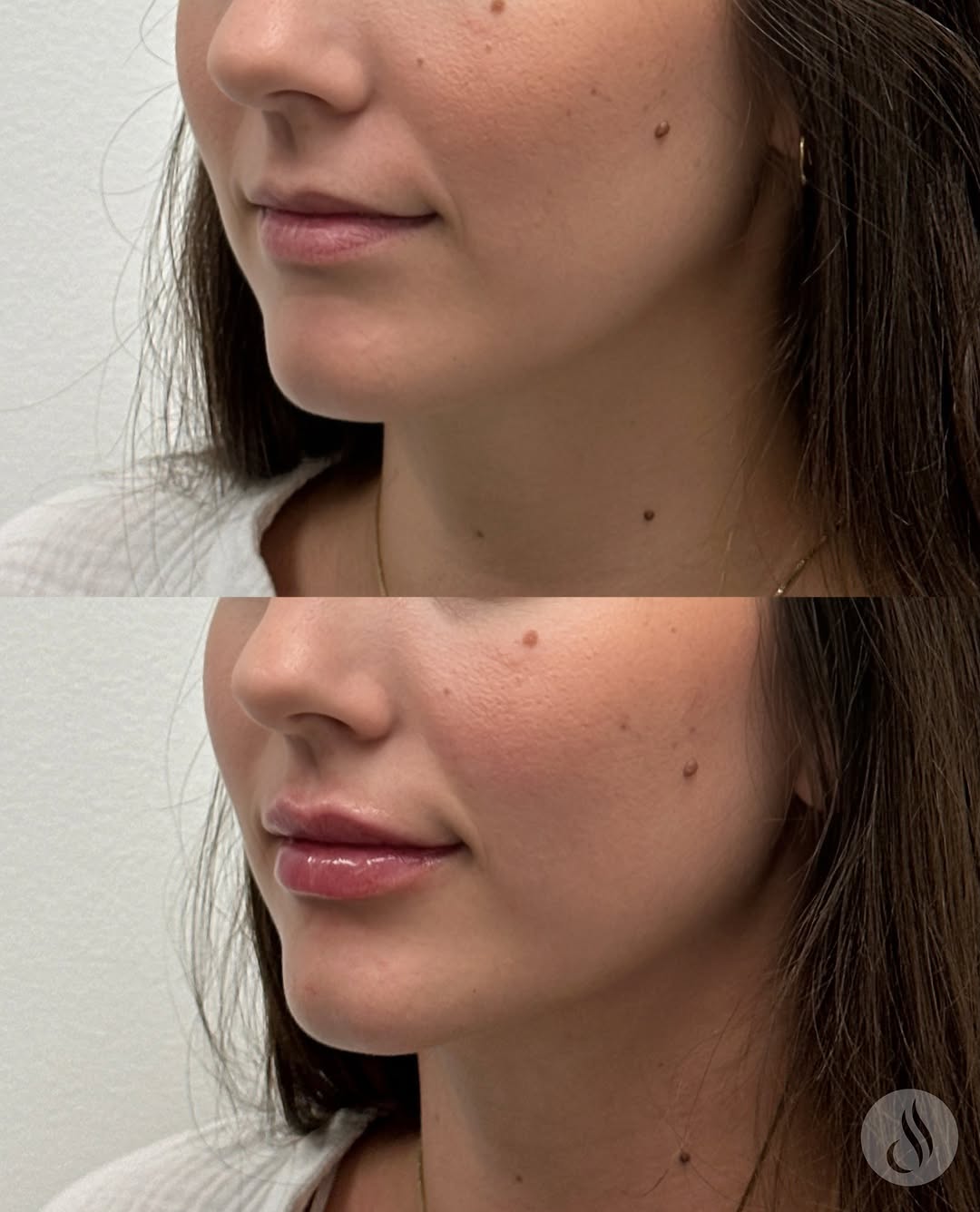 Instagram post by Dr. Stephen J. Delatte: The power of one syringe 💉💋 Volbella is that girl! Great for subtle volume, soft definition, and smoothing fine lines around the lips. Vol…