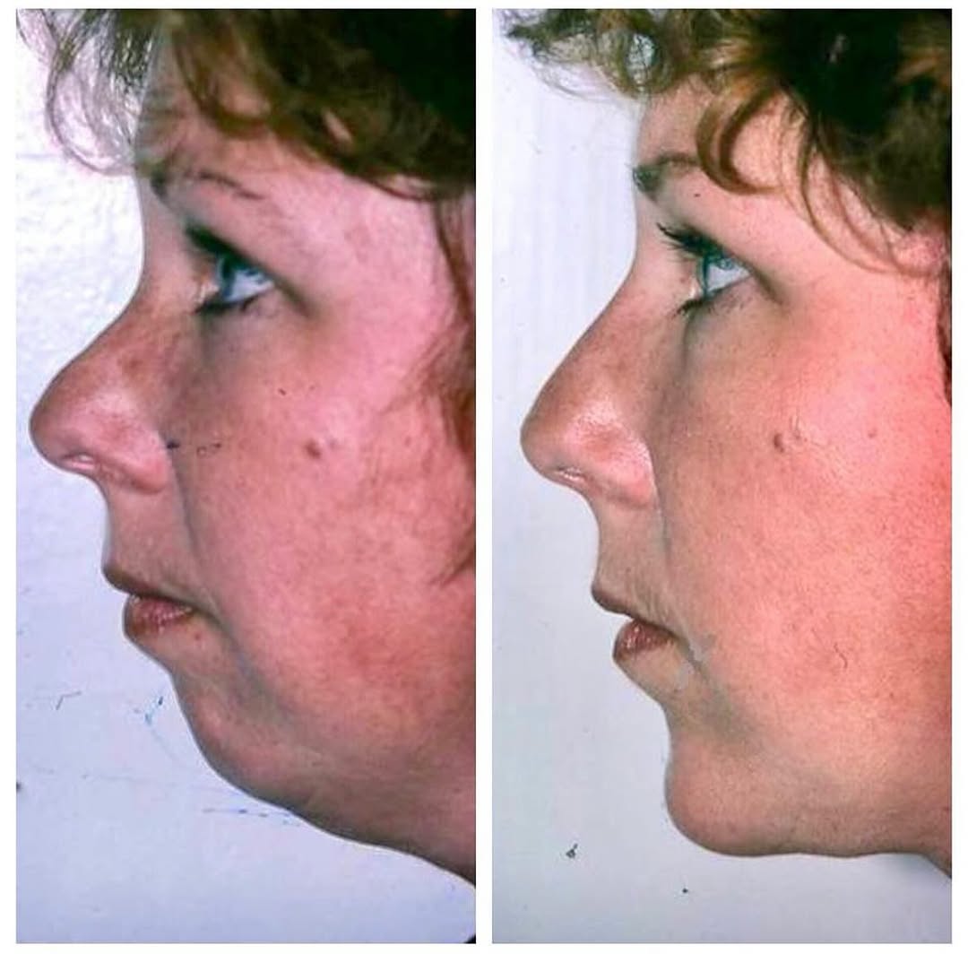 Instagram post by Dr. Stephen M. Krant: Rhinoplasty and chin augmentation by Stephen M. Krant, MD, FACS. . . . . . . #skcliniclajolla #stephenkrantmd #chinaugmentation #facialconto…
