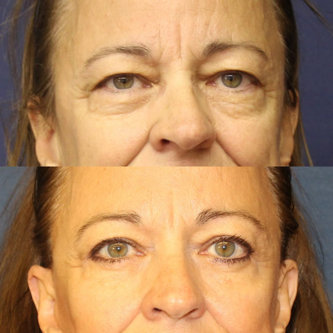 Instagram post by Dr. Stephen P. Beals: #QuadBlepharoplasty + #Browlift = 🤩 Combining an #upperblepharoplasty (removal of excess upper eyelid skin), #endoscopicbrowlift (lifting t…