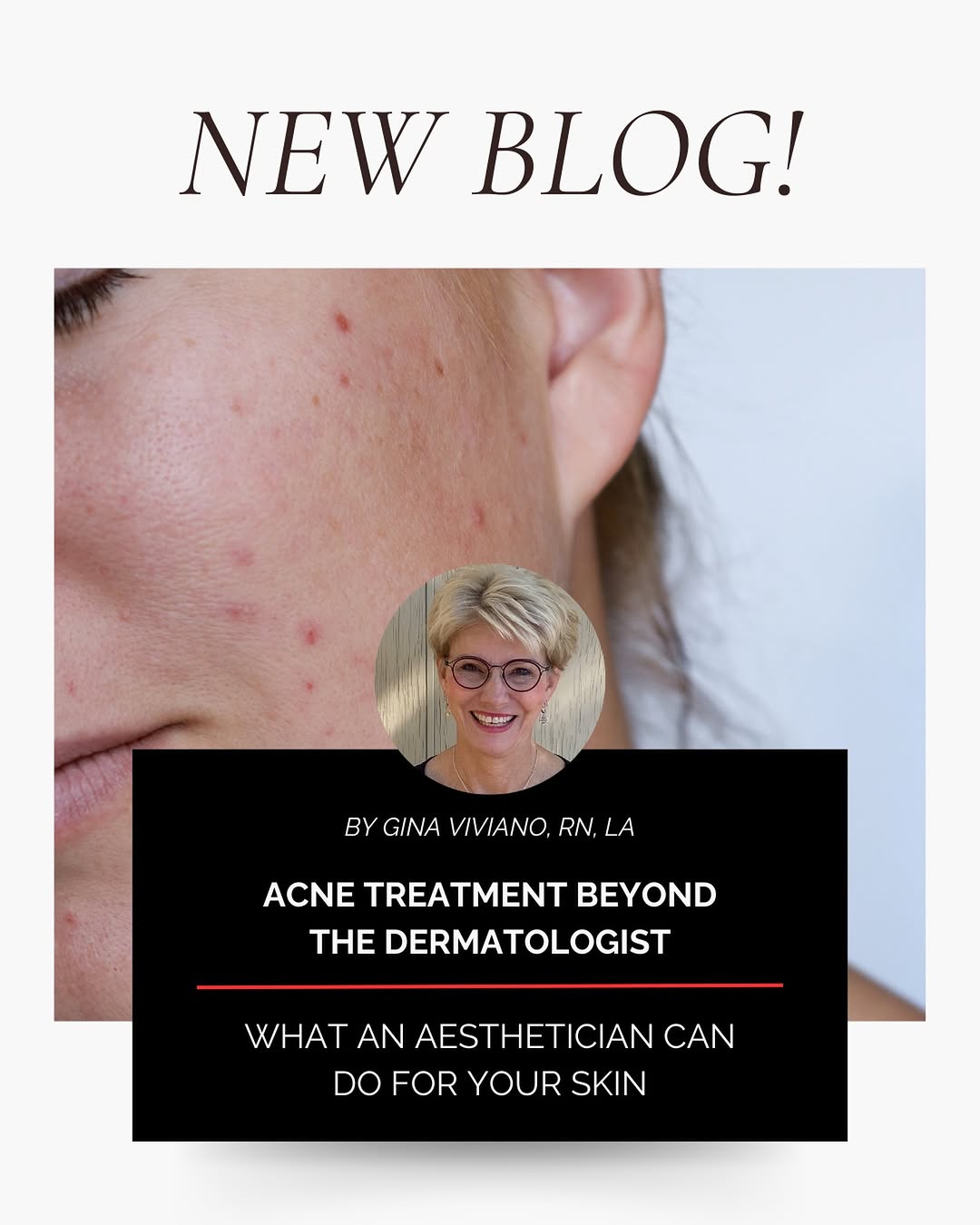 Instagram post by Dr. Stephen P. Beals: Acne is not just a “wash your face more” problem. It’s oil, bacteria, hormones, stress, friction, and sometimes the products you’re already …
