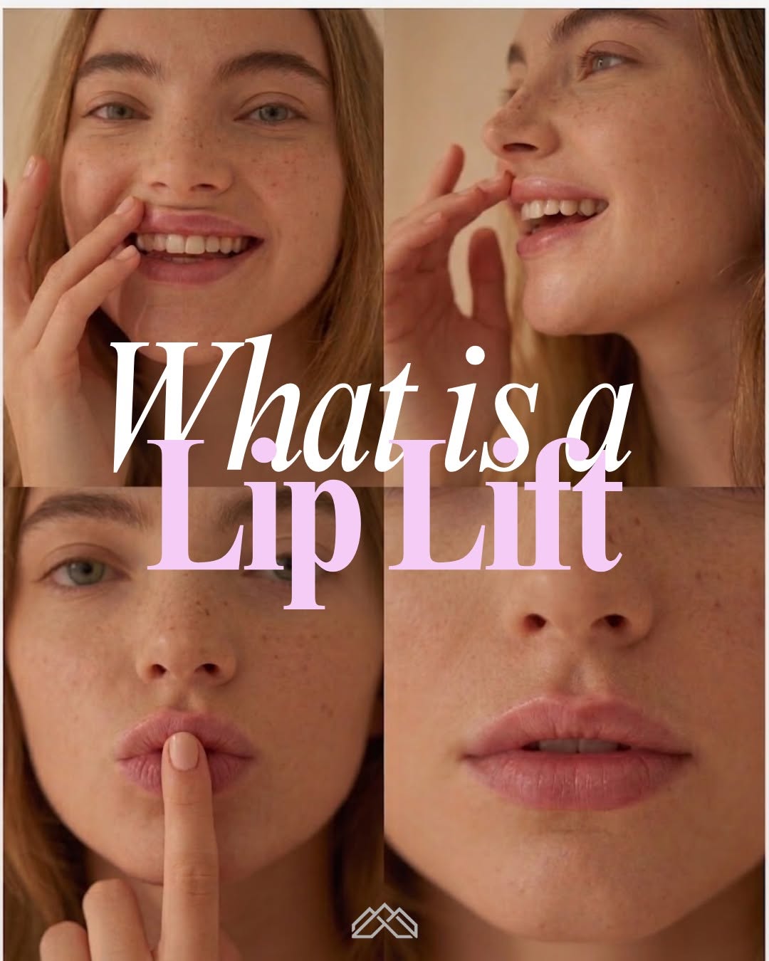 Instagram post by Dr. Stephen R. Sullivan: Restoring the upper lip. 💫 A lip lift shortens the philtrum—the space between your nose and lip—to naturally lift the upper lip, reveal mor…
