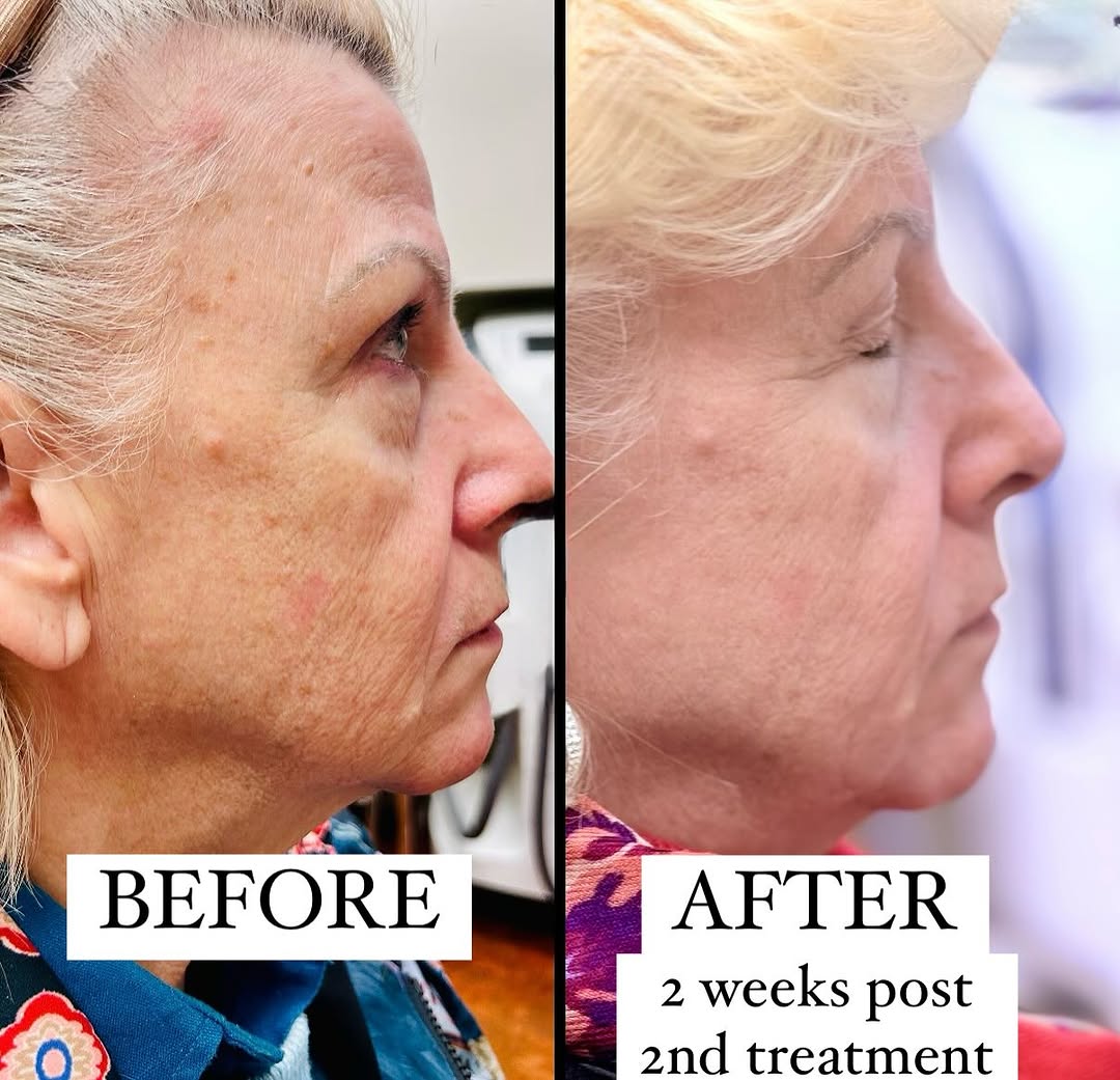 Instagram post by Dr. Stephen R. Weinman: Brighter, clearer skin with the Clear + Brilliant Laser. These gentle laser treatments are excellent for all skin types, all ages, all year …