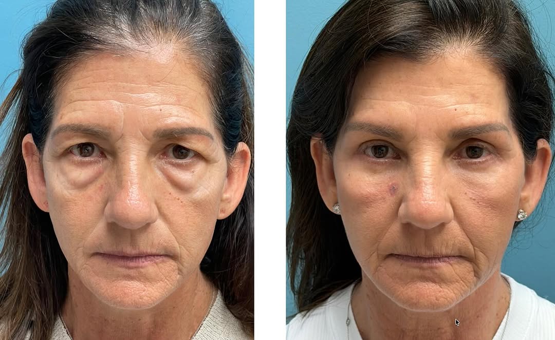 Instagram post by Dr. Steven Fagien: This lovely 62-year-old was referred to me by her Dermatologist for consideration of upper and lower blepharoplasty. She is now five months …