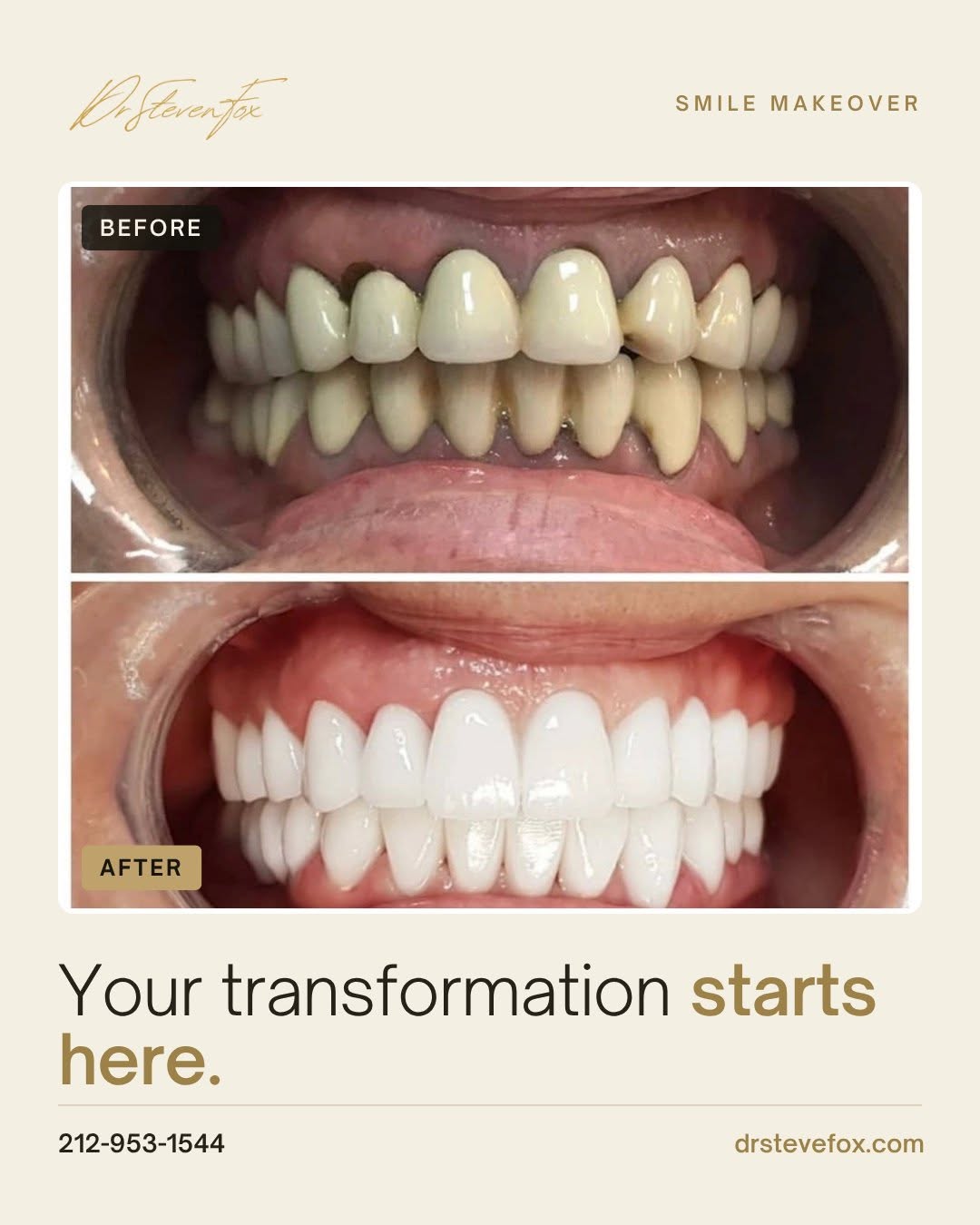 Instagram post by Dr. Steven Fox, DDS: Your transformation starts here. ✨ Every smile makeover is custom-designed by Dr. Fox — one of NYC's premier cosmetic dentists — for results…