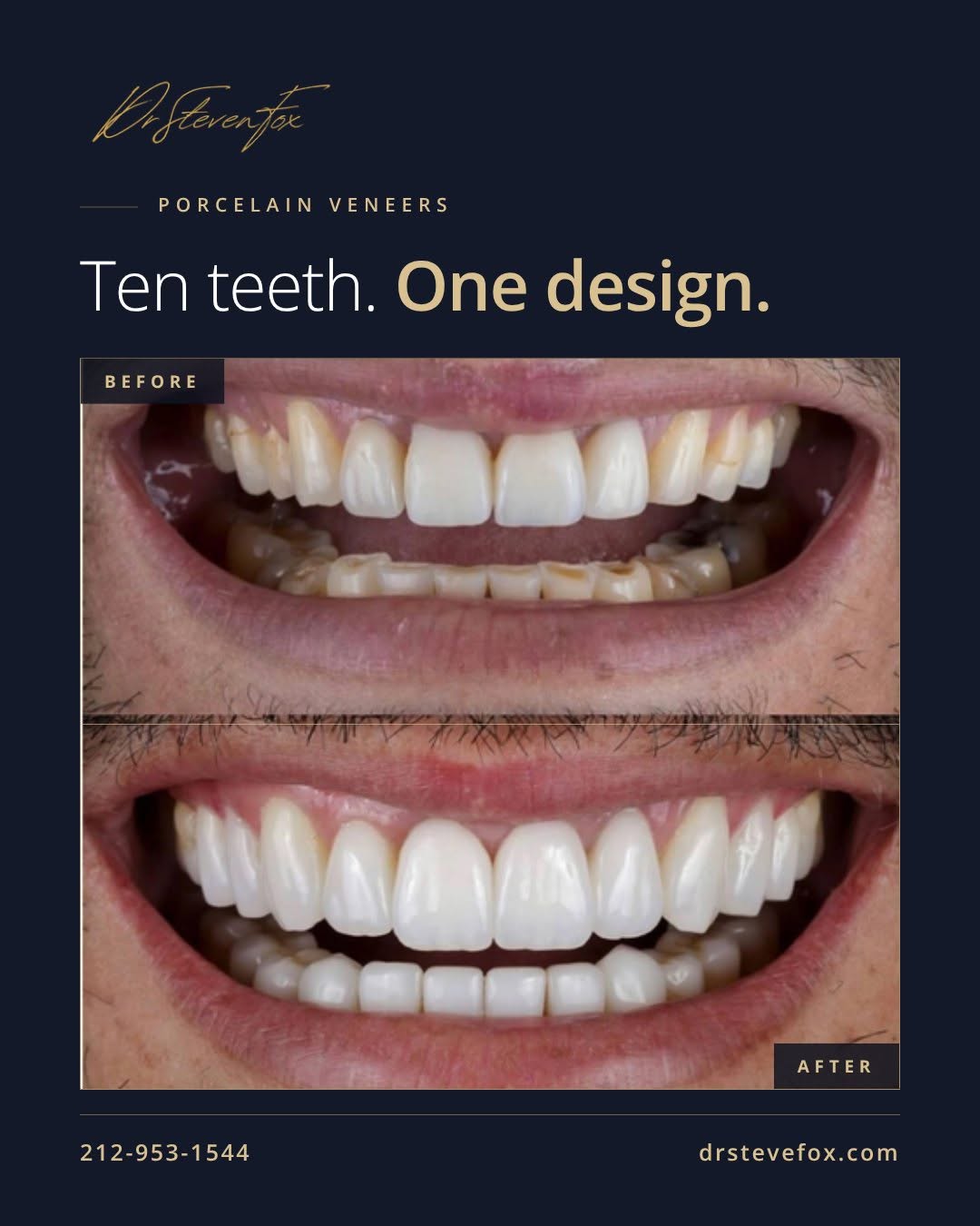 Instagram post by Dr. Steven Fox, DDS: A smile, redrawn. ✨ Every veneer case begins with proportion — how the teeth relate to the lip, the midline, and the face. The result reads …