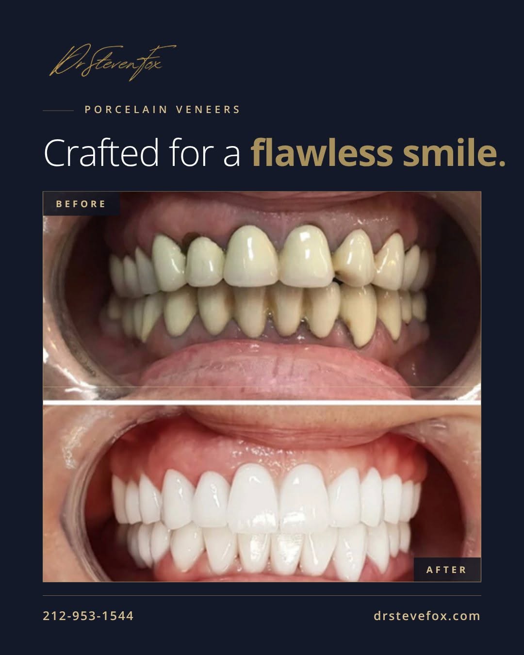 Instagram post by Dr. Steven Fox, DDS: The power of a smile makeover. Before and after porcelain veneers. Dr Fox served on the faculty of the Harvard School of Dental Medicine. Cr…