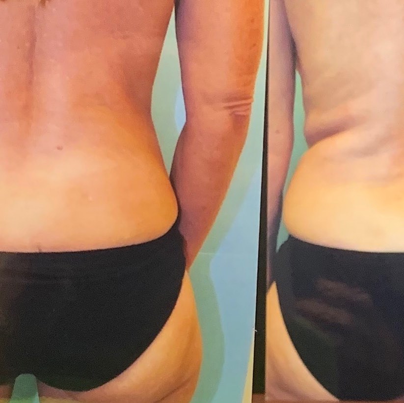 Instagram post by Dr. Steven H. Wiener: Steven Wiener MD. Call for a complimentary Cosmetic Consultation 480.596.6886 Ask about our Liposuction Specials!