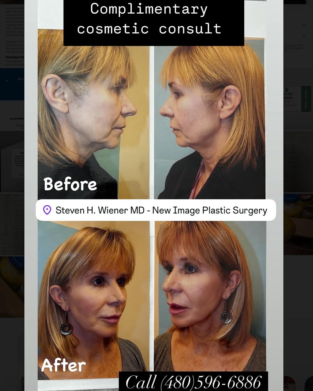 Instagram post by Dr. Steven H. Wiener: Facelift before and after on our beautiful patient. Call today for a complementary consultation at our Scottsdale location! #facelift #scott…