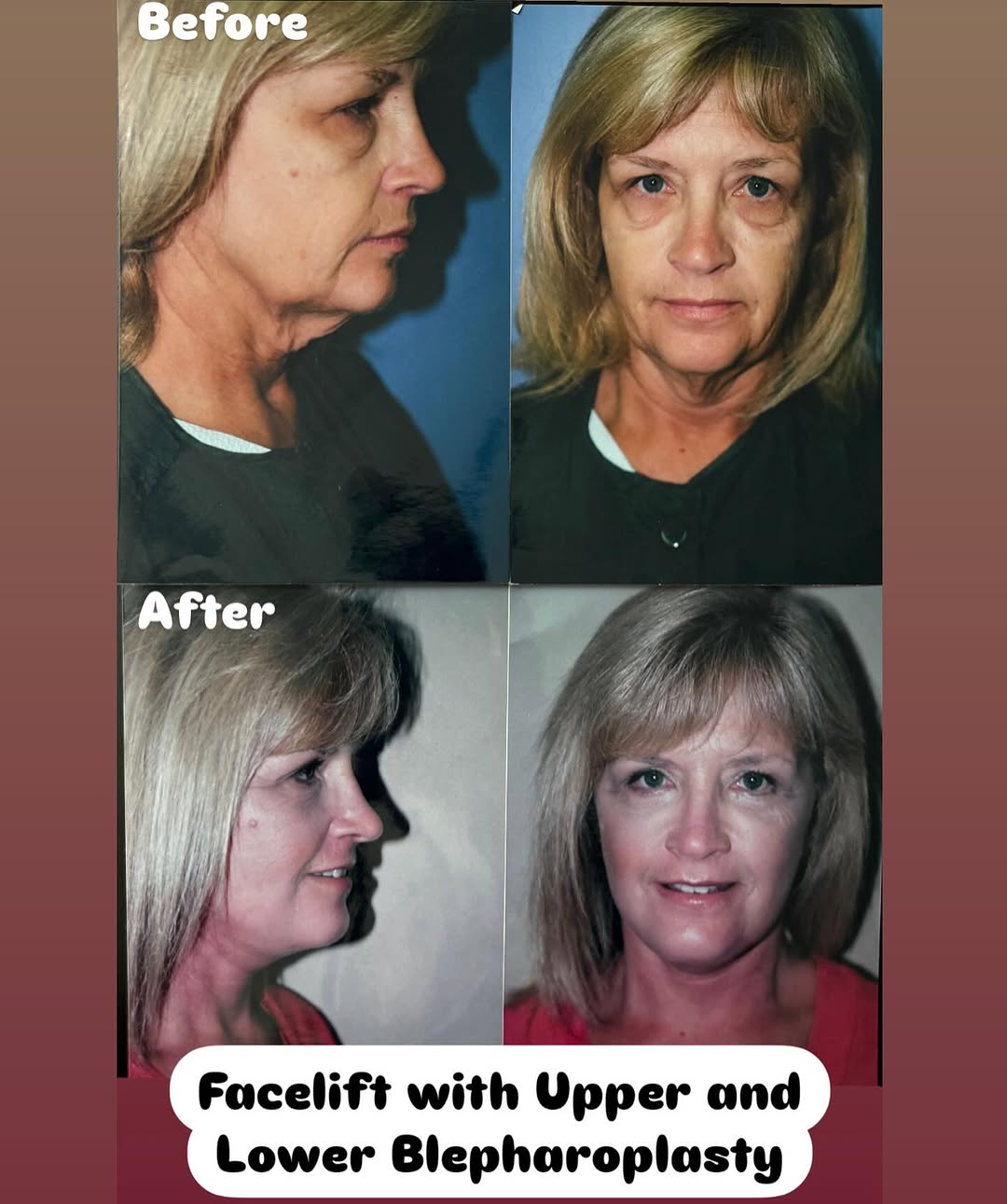 Instagram post by Dr. Steven H. Wiener: Facelift before and after! Along with Upper and Lower Blepharoplasty. We offer free consultations where you get to meet with board certified…