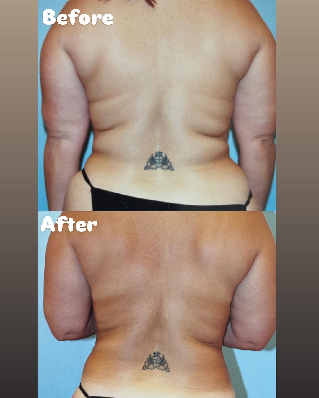 Instagram post by Dr. Steven H. Wiener: Liposuction before and after! Say goodbye to love handles 👋 Call for a free consultation today at (480) 596-6886 with board certified plast…