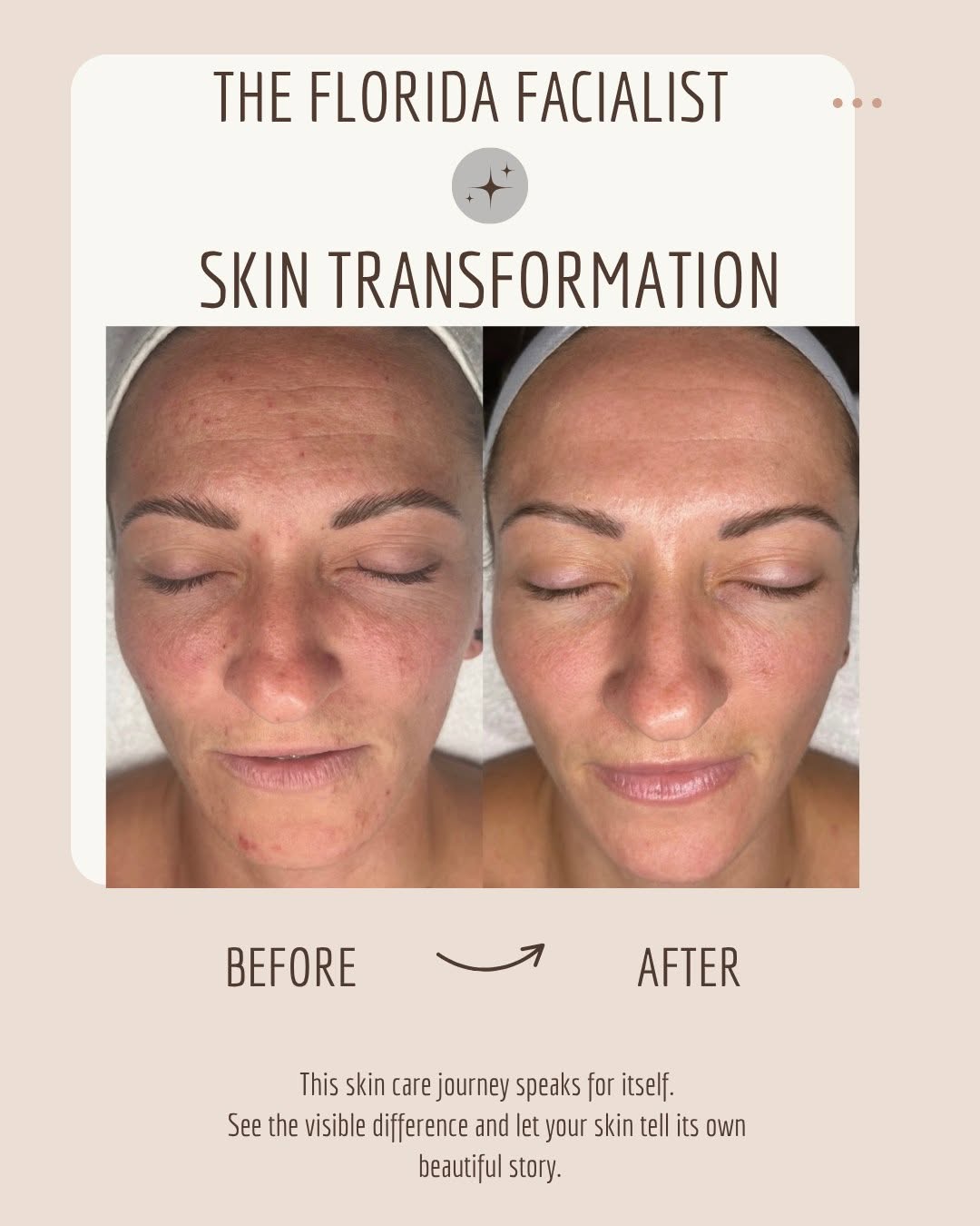 Instagram post by Dr. Steven Hacker: Want firmer, smoother, more even skin? Microneedling with Karyn helps your skin rebuild collagen from the inside out. ✨ It is fantastic for …