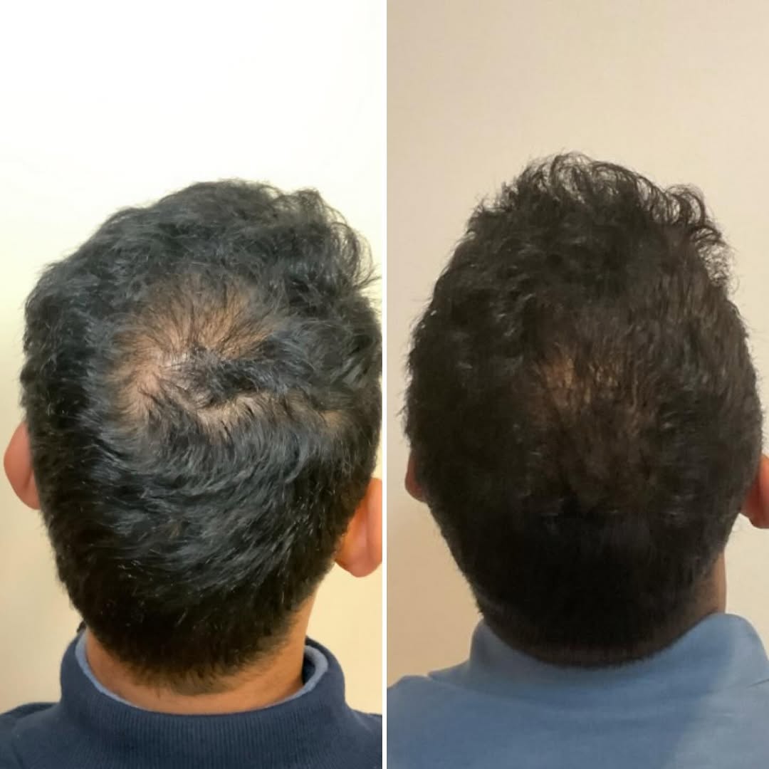 Instagram post by Dr. Steven L. Greene: ✨ Hair Restoration Success! ✨ Here’s one of our happy patients who saw impressive results after a series of PRP (Platelet-Rich Plasma) treat…