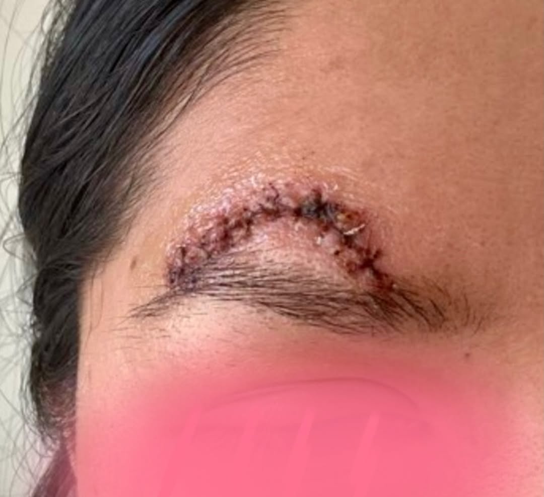 Instagram post by Dr. Steven L. Greene: ✨ Scar treatment can be about more than appearance, it can be about comfort, confidence & healing. At Advanced Dermatology & Laser Institute…