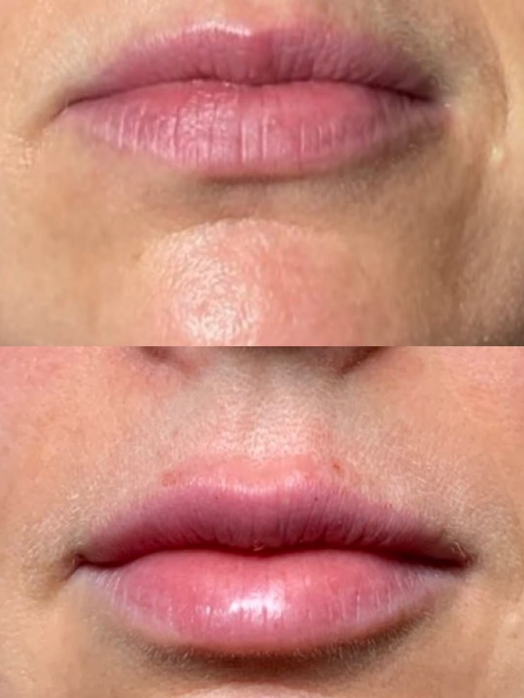 Instagram post by Dr. Steven L. Greene: Lip filler is a popular technique to subtly enhance the shape and size of the lips. As we age, the natural plumpness of the red part of our …