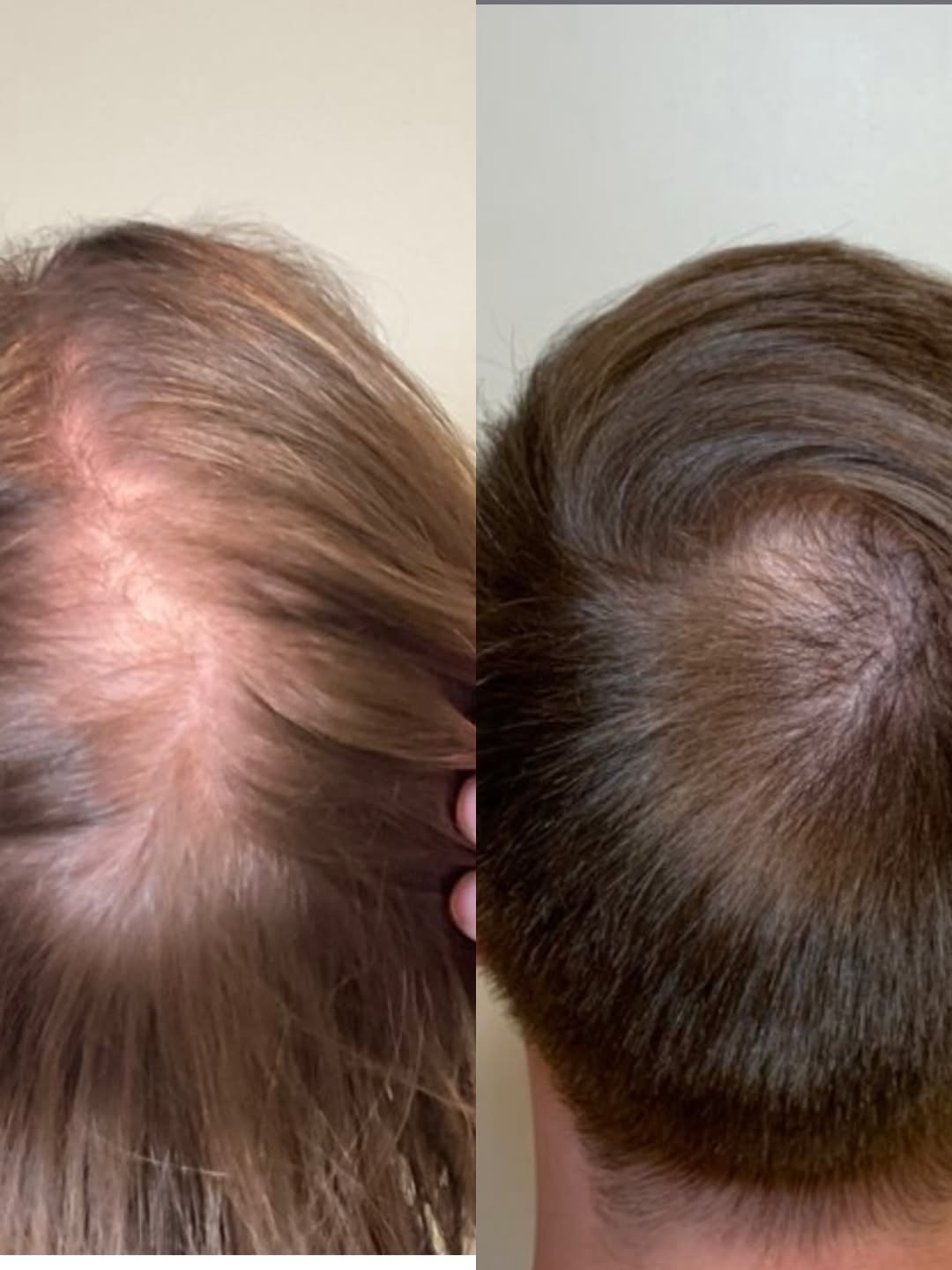 Instagram post by Dr. Steven L. Greene: Check out this incredible 9-month hair restoration journey! 👀 After starting a personalized regimen that included Viviscal PRO supplements,…