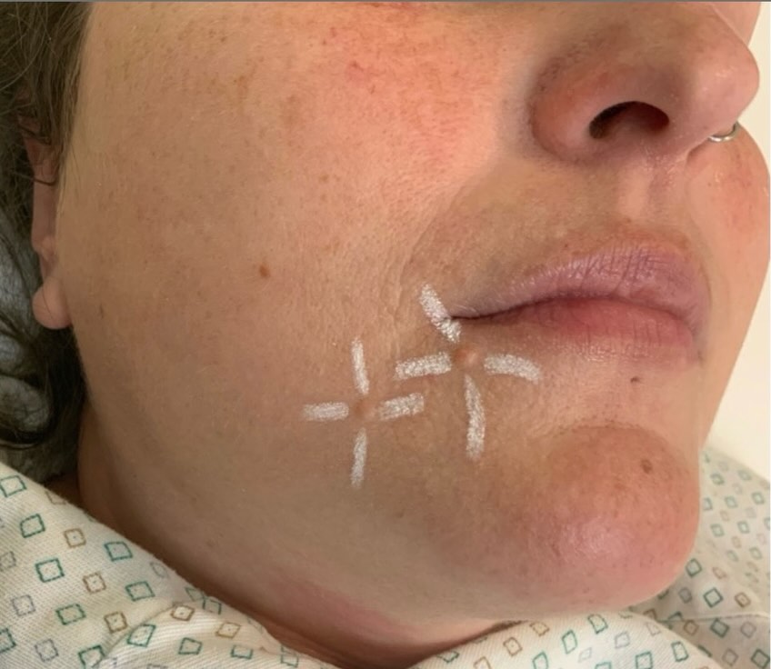 Instagram post by Dr. Steven L. Greene: ✨ Your Skin. Your Confidence. Your Choice. ✨ Moles can be more than just a cosmetic concern. This patient came to us to remove two benign mo…