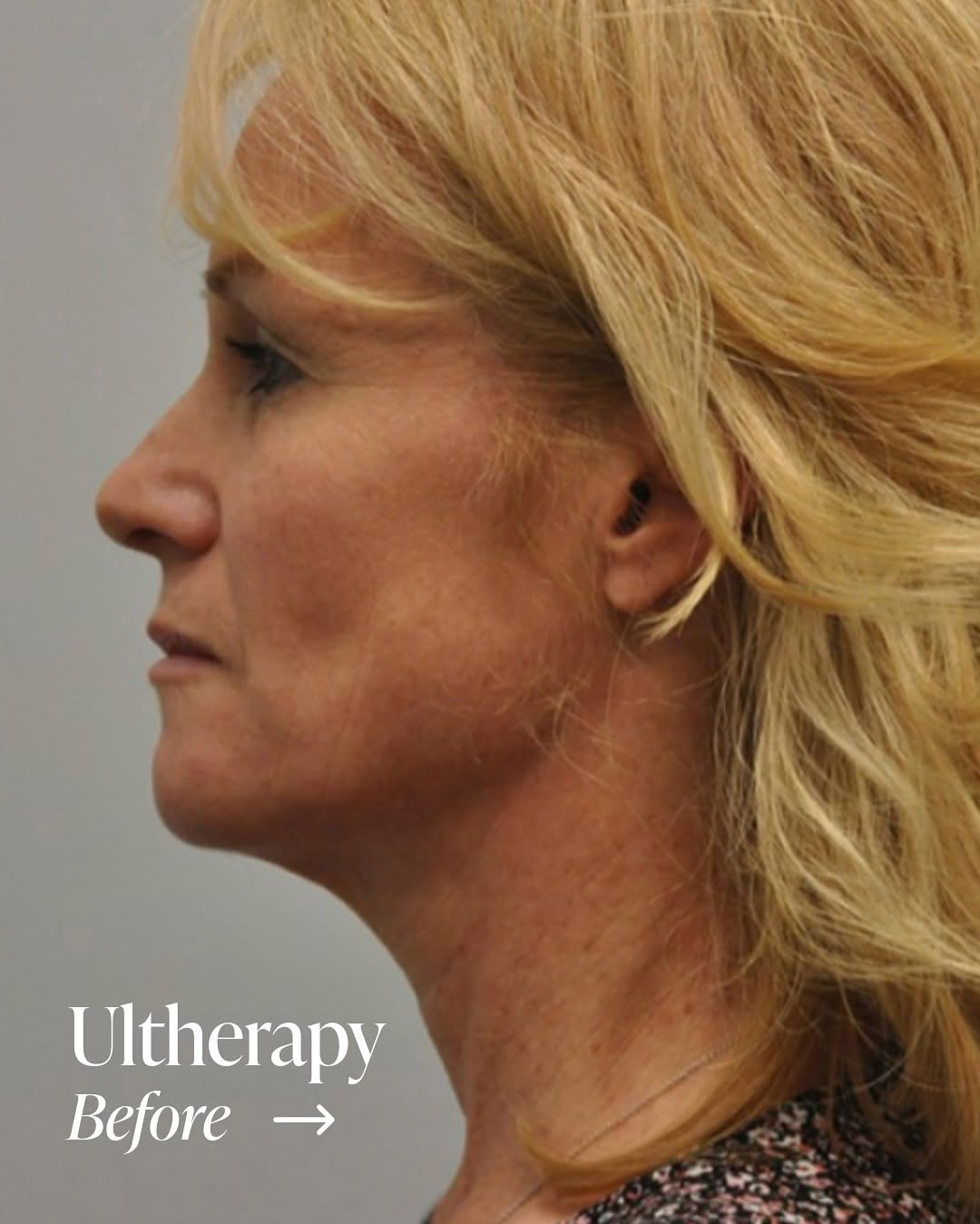 Instagram post by Dr. Steven L. Ringler: Lift. Tighten. Define. ✨ Ultherapy® uses focused ultrasound to naturally lift and tighten skin on the face, jawline, and neck — with no need…