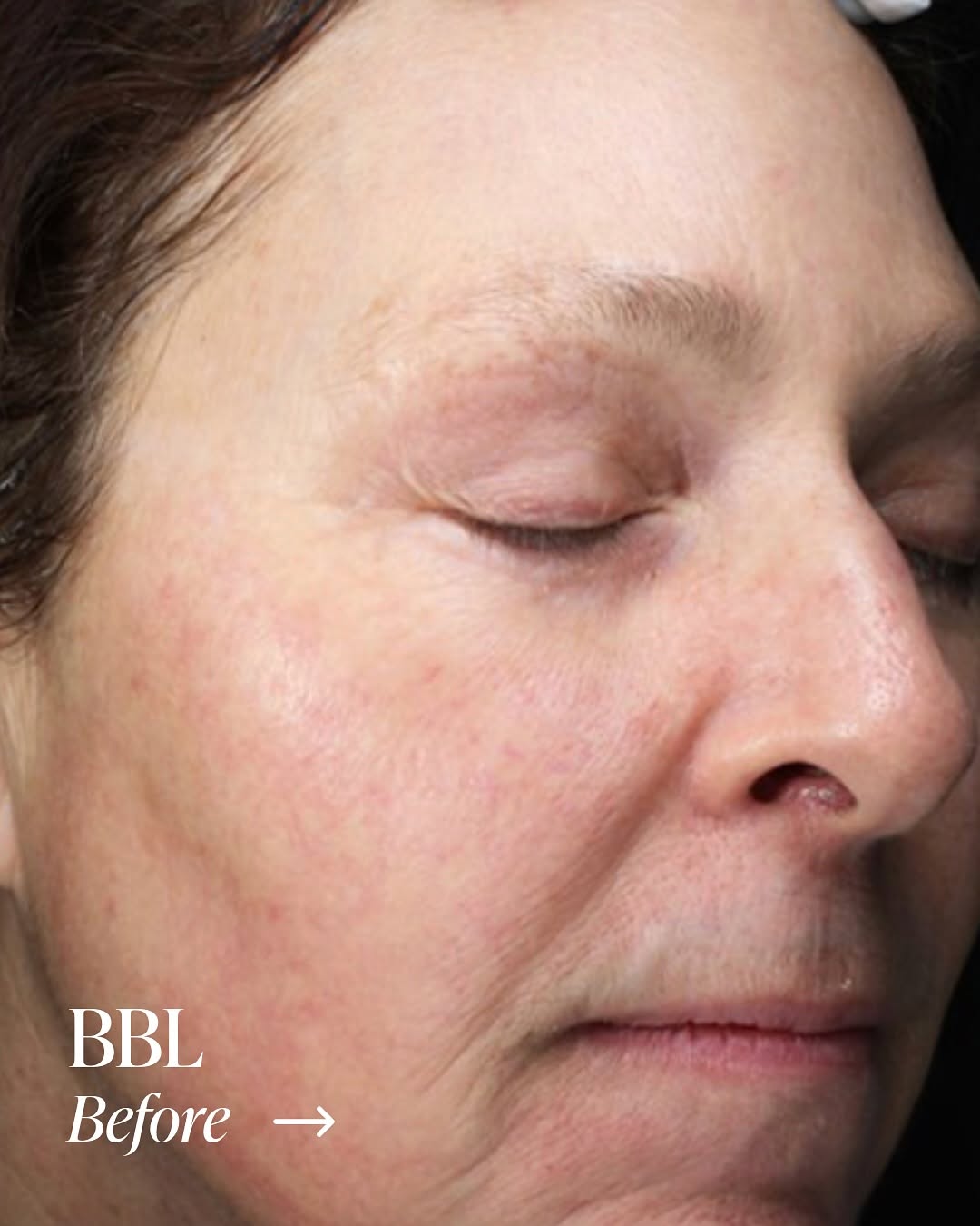 Instagram post by Dr. Steven L. Ringler: Brighter, smoother, more even skin ✨ This patient’s results show the power of BBL™ (BroadBand Light) — targeting sun damage, redness, and un…