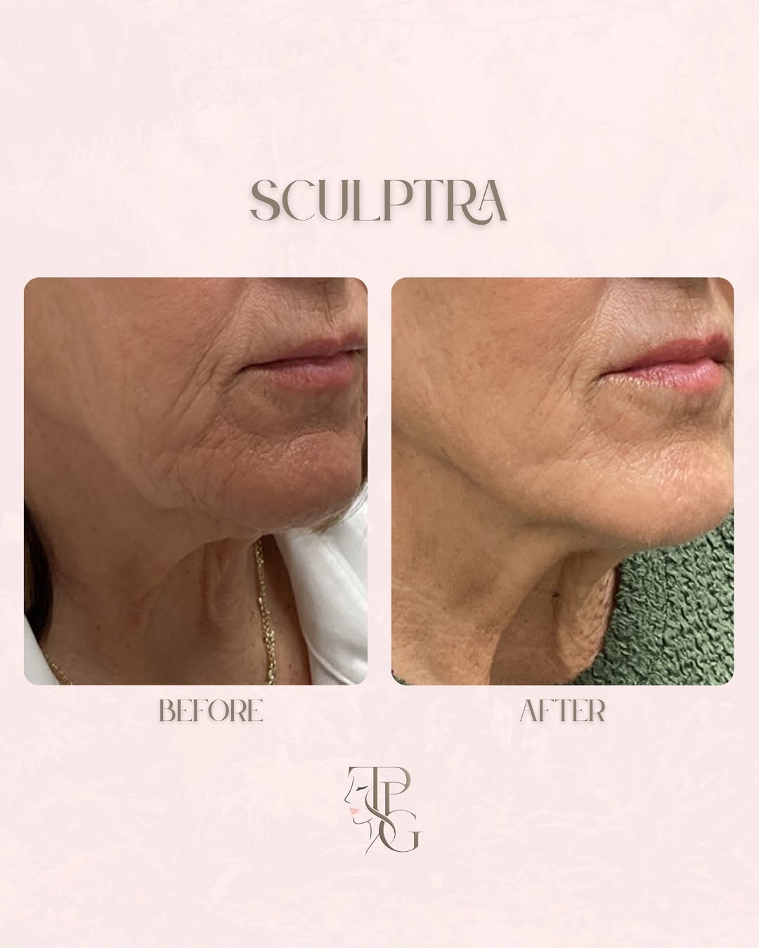 Instagram post by Dr. Steven L. Robinson: Collagen, restored naturally✨ Sculptra works differently than traditional fillers by stimulating your body’s own collagen production for gra…