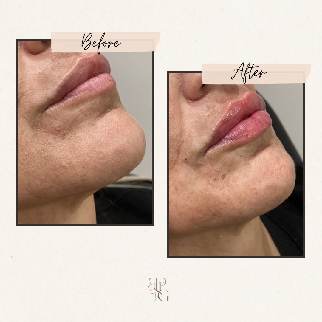 Instagram post by Dr. Steven L. Robinson: Less is more. A little volume, enhanced definition, and beautifully hydrated lips can make all the difference. This customized treatment was…