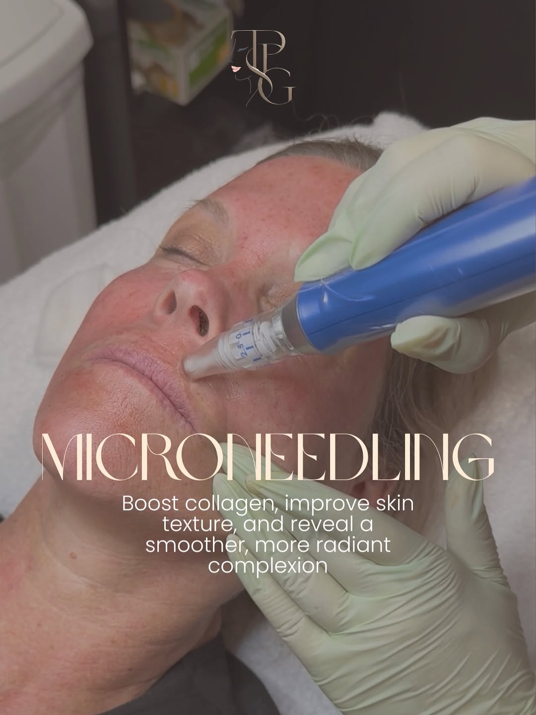 Instagram post by Dr. Steven L. Robinson: What if one treatment could help with: ✨Fine lines ✨Acne scars ✨Enlarged pores ✨Uneven texture ✨Dull skin Microneedling encourages your skin…
