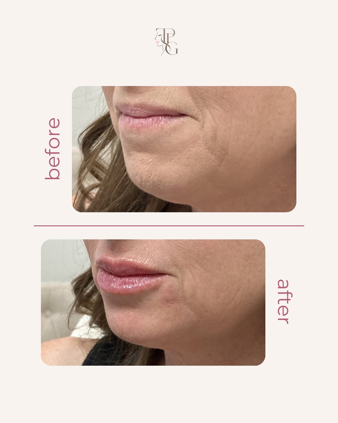 Instagram post by Dr. Steven L. Robinson: Subtle changes. Beautiful results. ✨ A little enhancement can go a long way toward creating a more balanced, refreshed, and natural-looking …