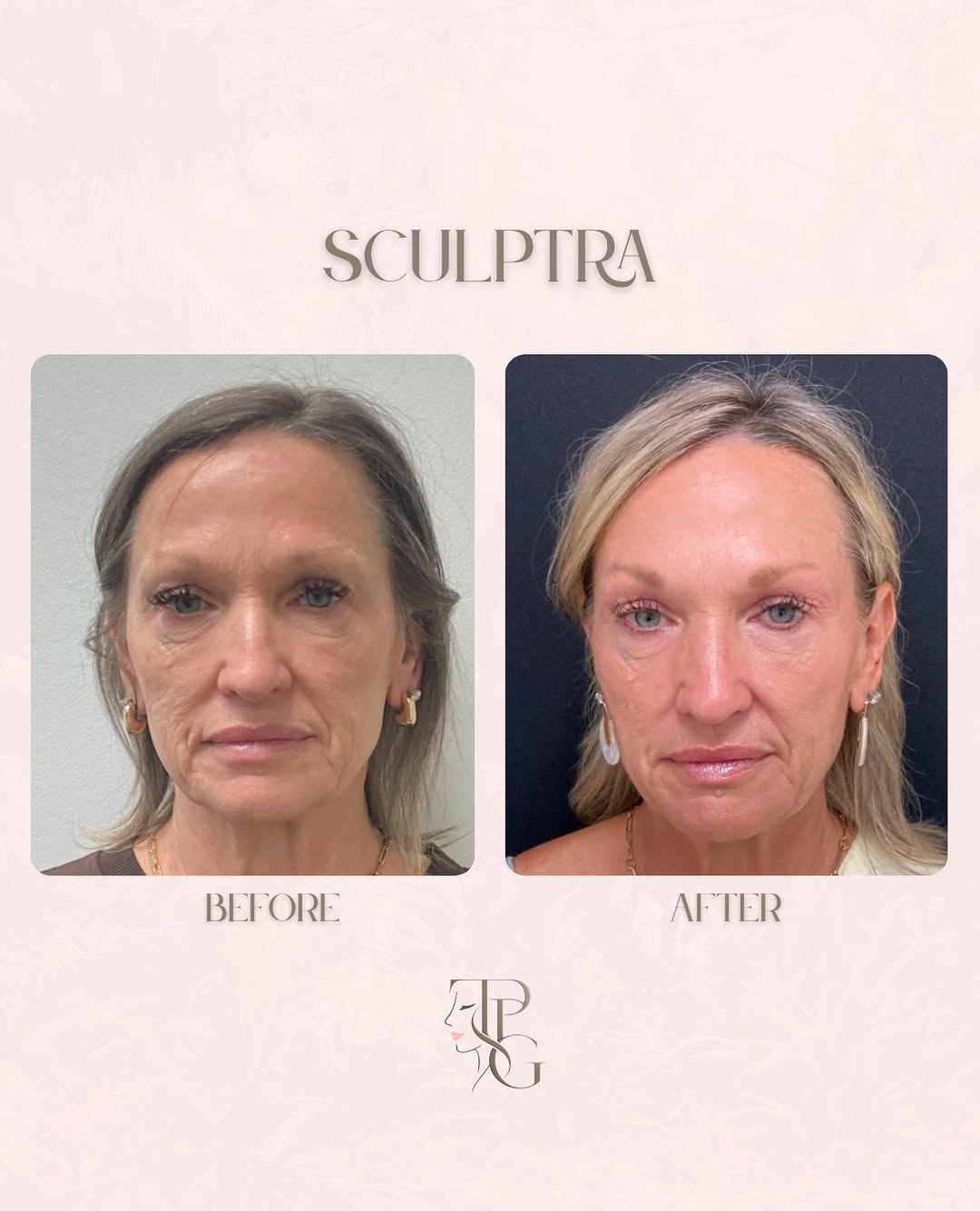Instagram post by Dr. Steven L. Robinson: More than a quick fix — think long-term skin rejuvenation. Meet Sculptra®, an injectable treatment designed to gradually stimulate your skin…