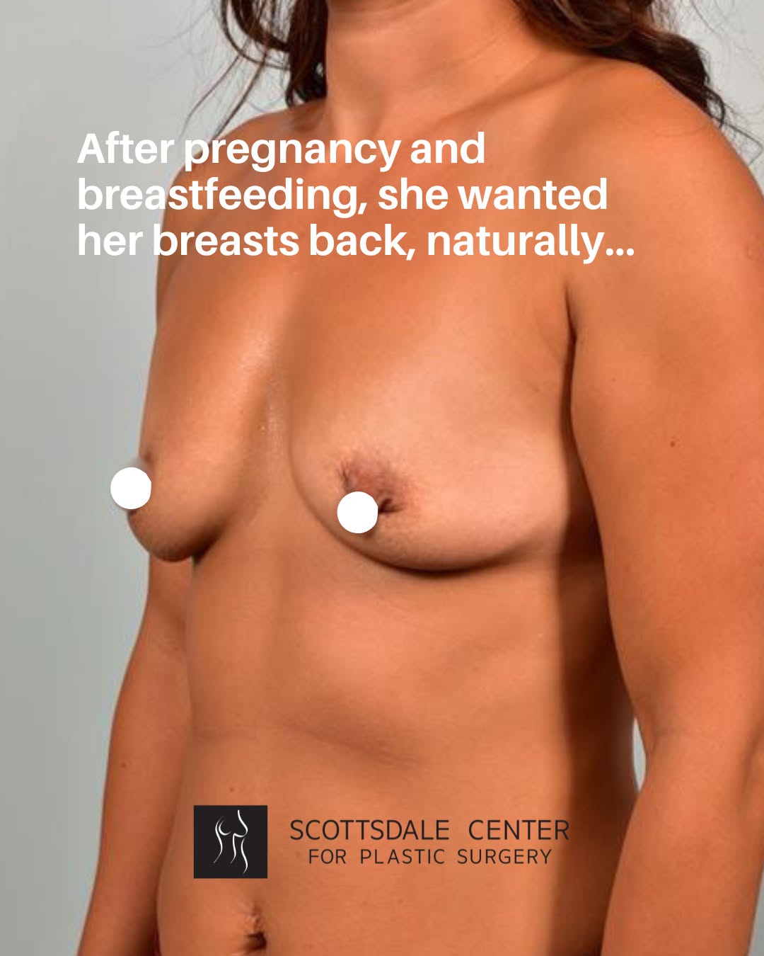 Instagram post by Dr. Steven Sigalove: This 36-year-old patient wanted to restore volume and improve the overall proportion of her breasts while maintaining a natural appearance.…