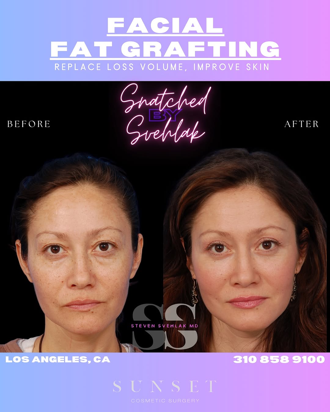 Instagram post by Dr. Steven Svehlak: Here is a procedure that will help you reach your anti-aging skin goals 💉✨ FACIAL FAT GRAFTING ✨Reduces wrinkles ✨Improves Skin Texture ✨Pr…