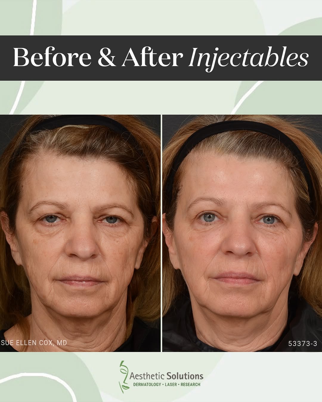 Instagram post by Dr. Sue Ellen Cox: Beautiful results just two weeks after one session of hyaluronic acid filler. Midface volume has been restored, helping to provide foundatio…