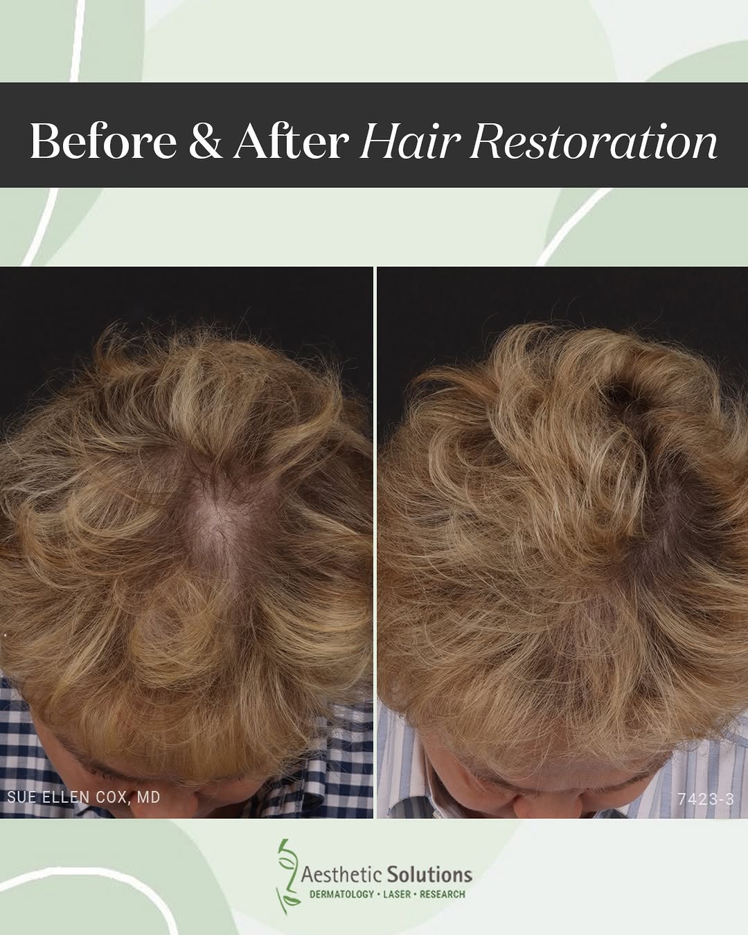 Instagram post by Dr. Sue Ellen Cox: Incredible hair restoration results by my PA team after prescription therapy combined with a series of PRP treatments! ✨ PRP (platelet-rich …