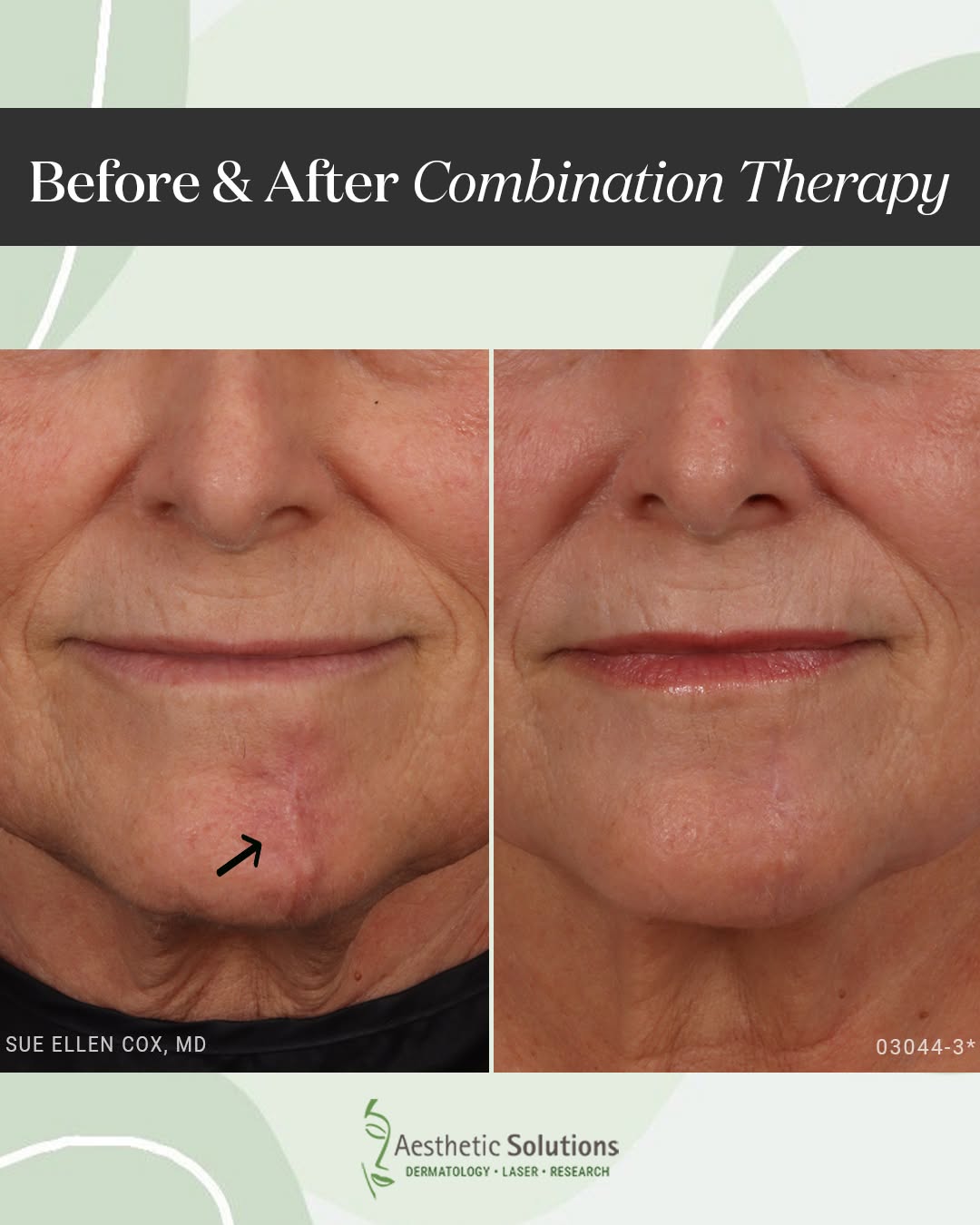 Instagram post by Dr. Sue Ellen Cox: Beautiful improvement in this patient's chin scar after a combination of V-beam, Fraxel Dual, and a neuromodulator. Each treatment was chose…