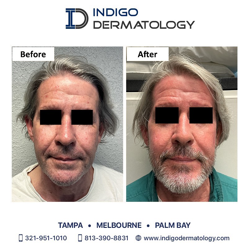Instagram post by Dr. Sumeet Thareja: Patient had concerns about uneven skin pigmentation and texture. He had a medium depth peel performed by Dr. Batra. Results at 1 week show r…