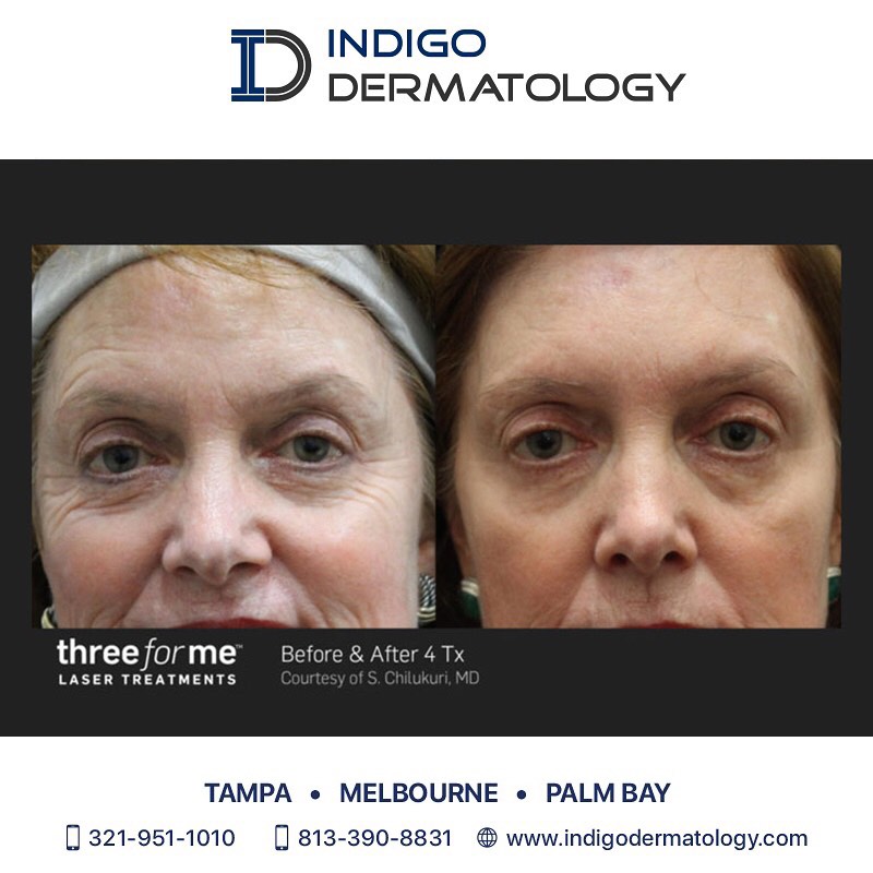 Instagram post by Dr. Sumeet Thareja: 'Before & After 4 Treatments of Intense Pulsed Light' - Indigo Dermatology offers IPL treatment, an all-in-one skin revitalization therapy t…