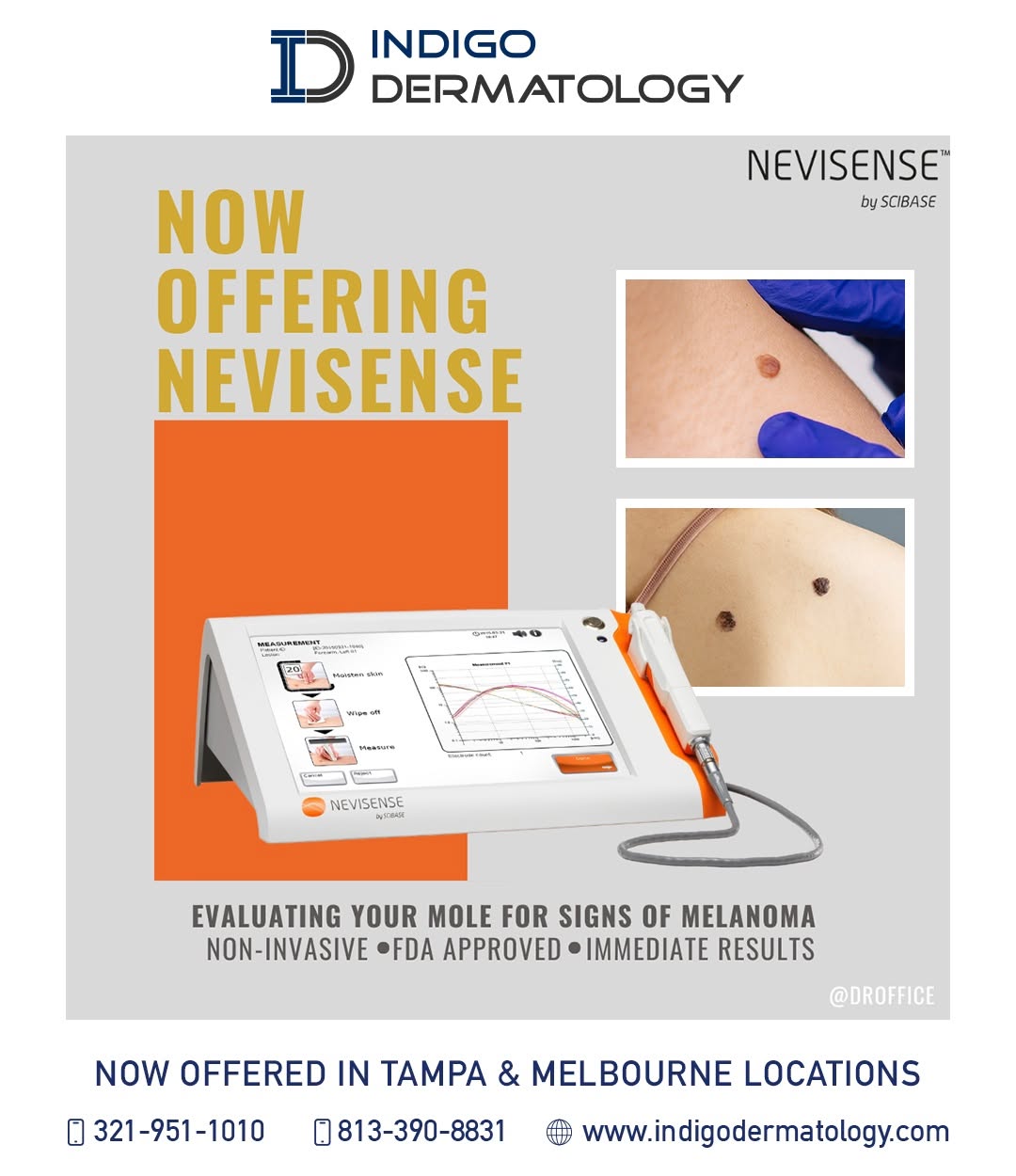 Instagram post by Dr. Sumeet Thareja: Early detection can make all the difference when it comes to skin cancer. Introducing 'Nevisense' at Indigo Dermatology, an advanced, non-in…