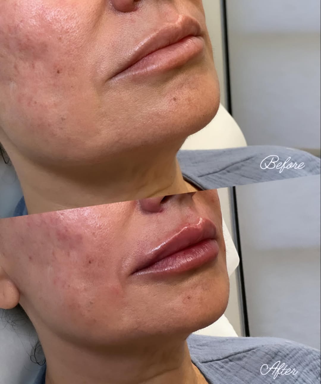 Instagram post by Dr. Summer Swanick, N: Look at this lip transformation by Dr. Swanick😍 #lipfillers #plumplips #holidayready #juvederm