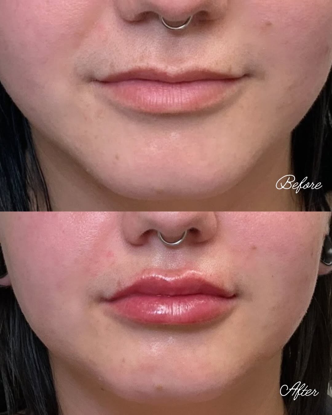 Instagram post by Dr. Summer Swanick, N: Check out these amazing results by Dr.Swanick ! 😍😍😍 #lips #filler #aesthetics