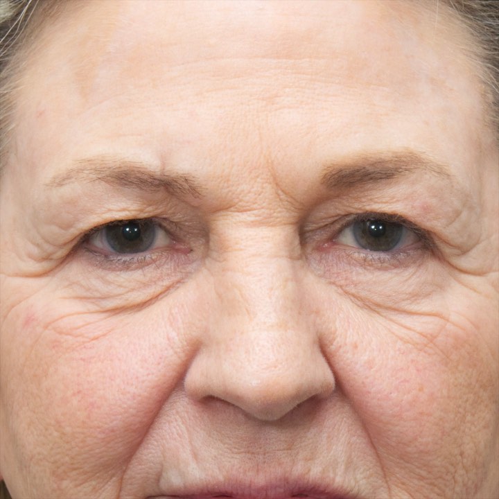 Instagram post by Dr. Summit Kundaria: Watch our patient’s upper blepharoplasty surgery before and afters. These images show results after two years! #upperblepharoplasty #CLT #fa…