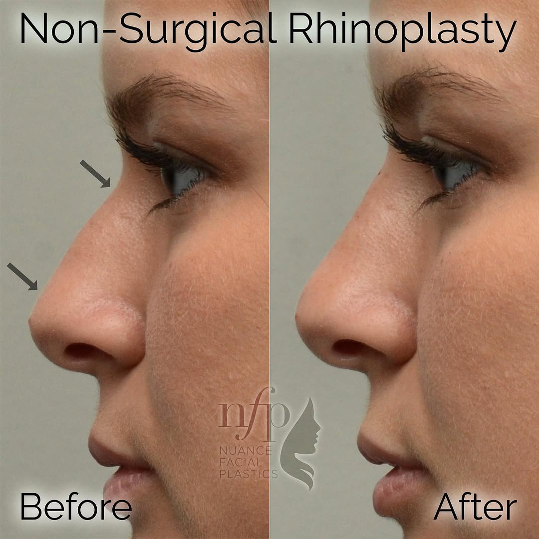 Instagram post by Dr. Summit Kundaria: A non-surgical rhinoplasty can be helpful for: ▫️Instantly improving profile ▫️Reducing the appearance of a hump on the bridge of the nose ▫…
