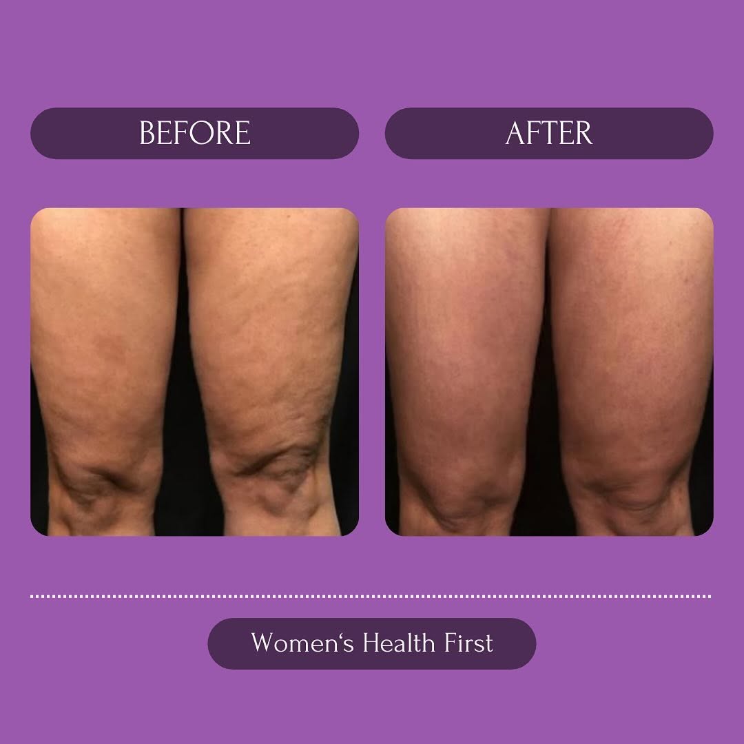 Instagram post by Dr. Susan Forster: What do we mean when we say Morpheus8 Sculpts, Lifts, Defines, and Tightens? 🔥 The RF pairing with microneedling “shrink wraps” skin allowi…