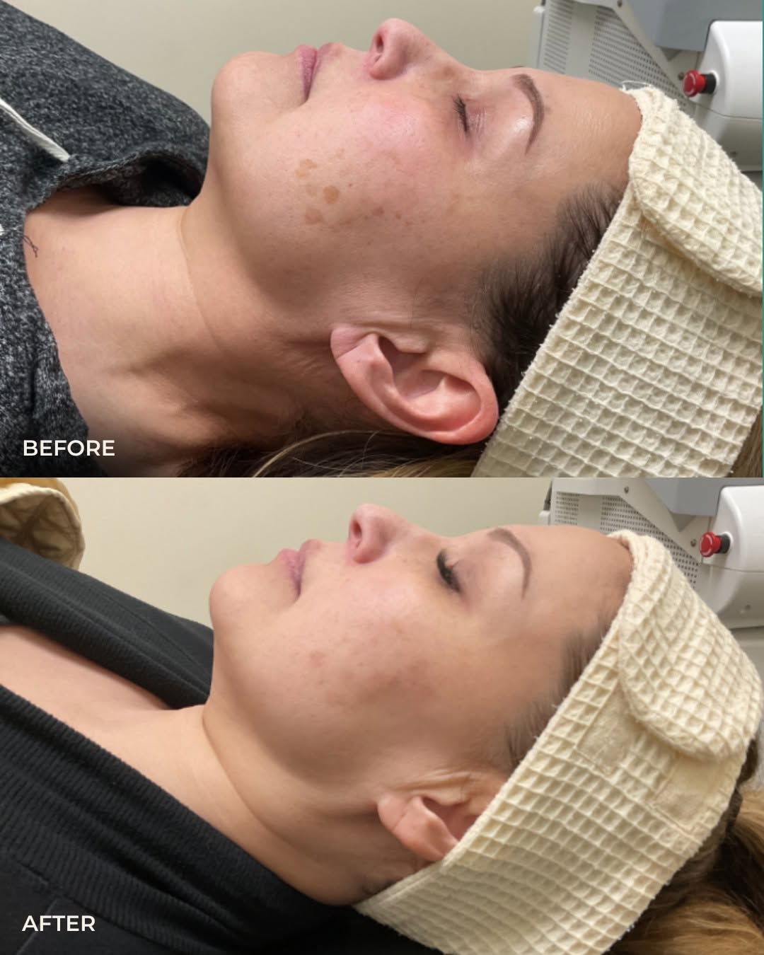 Instagram post by Dr. Susan Mathison: This patient completed just TWO photofacial laser treatments and already saw a noticeable reduction in hyperpigmentation 🙌 The best part? P…